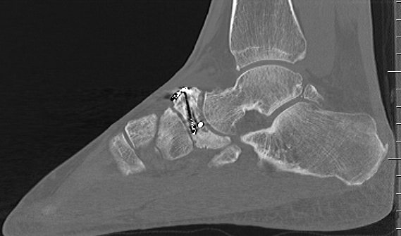 Navicular ORIF 1